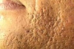 Acne litteken voor de behandeling - Acne en Littekens verwijderen - Huidzorg Klinieken