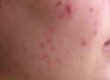 Actieve acne voor de behandeling - Acne behandelen - Huidzorg Klinieken