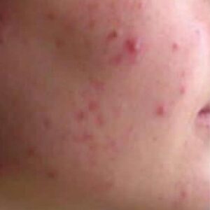 Actieve acne voor de behandeling - Acne behandelen - Huidzorg Klinieken