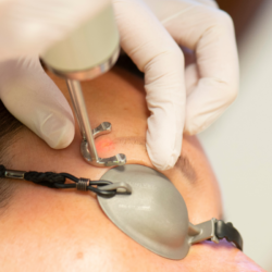 Permanente make-up verwijderen